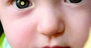 Avance del cáncer ocular infantil